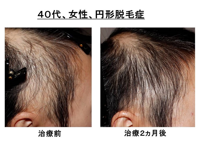 円形脱毛症　病院